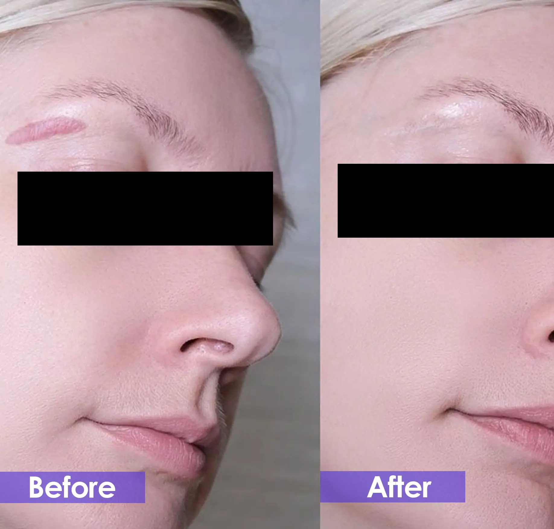scar removal for face